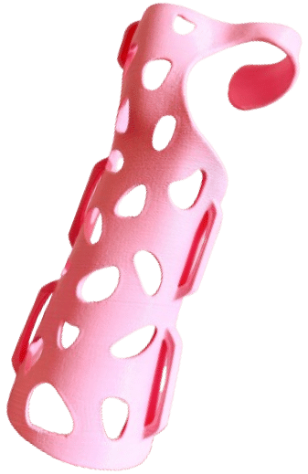 Pink 3D printed cast by Dimension Ortho